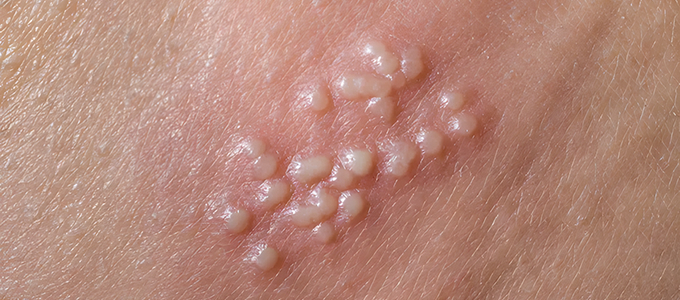 Herpes Genitales
