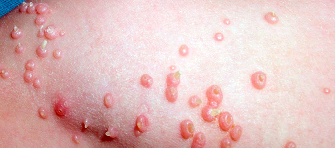 Molusco Contagioso